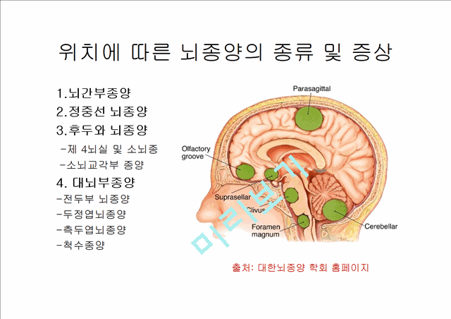 [4000원] 뇌종양종류 및 증상,양성종양 VS 악성종양,뇌종양 수술 방법,뇌종양에 좋은 음식,뇌농양,두부손상,두부손상 응급처치,두부손상에 의한 질환.pptx